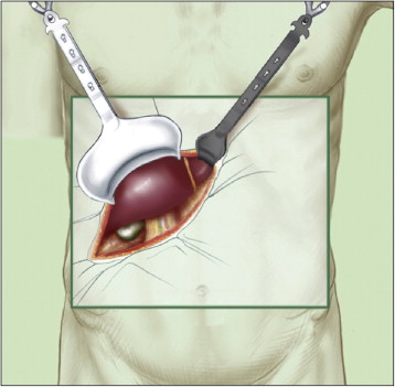 A depiction of open liver surgery