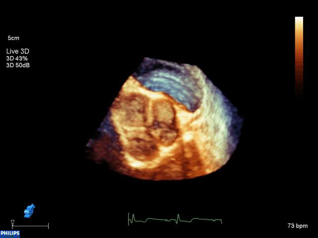 Doppler Ultrasound