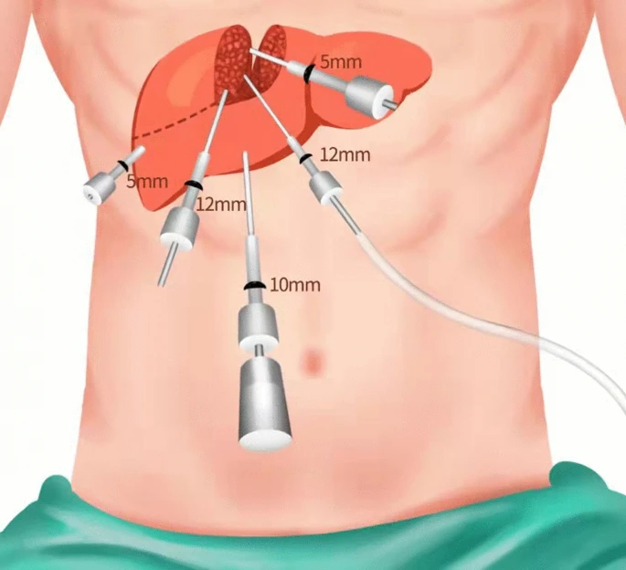 A depiction of laparoscopic liver surgery