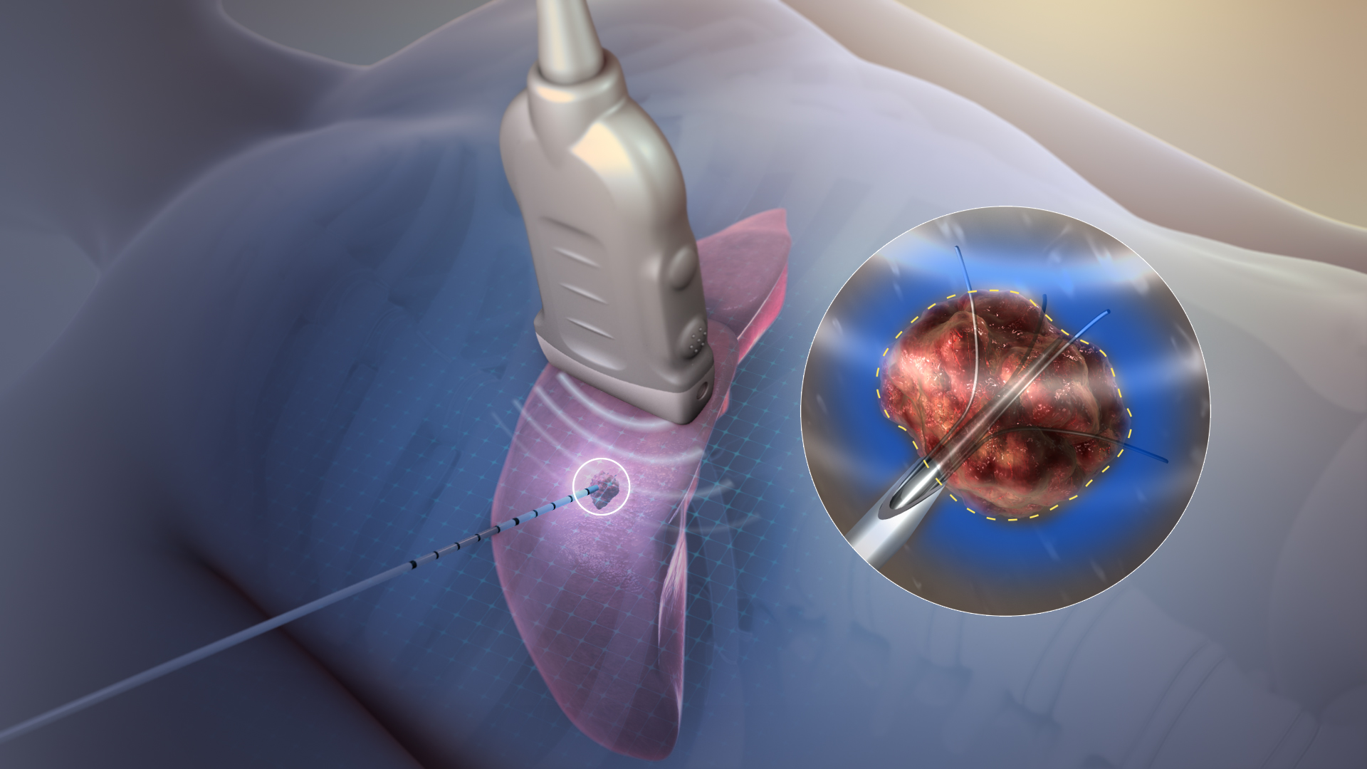 Tissue ablation using radiofrequency