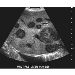 A ultrasound image of liver with metastatic cancer growths