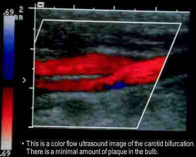 Doppler Ultrasound