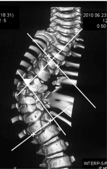 Cobb angle to measure scoliosis