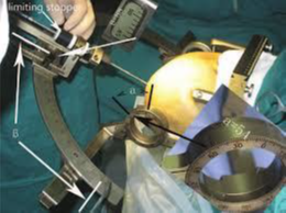 Laksell Frame used in surgery