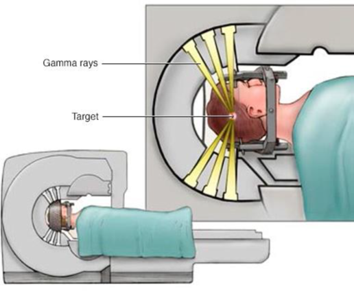 Gamma rays enter head in radiosurgery